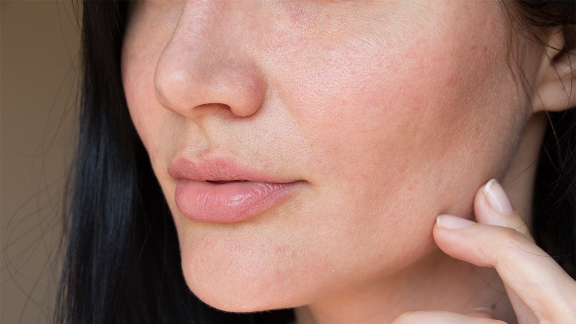 sucha skóra twarzy