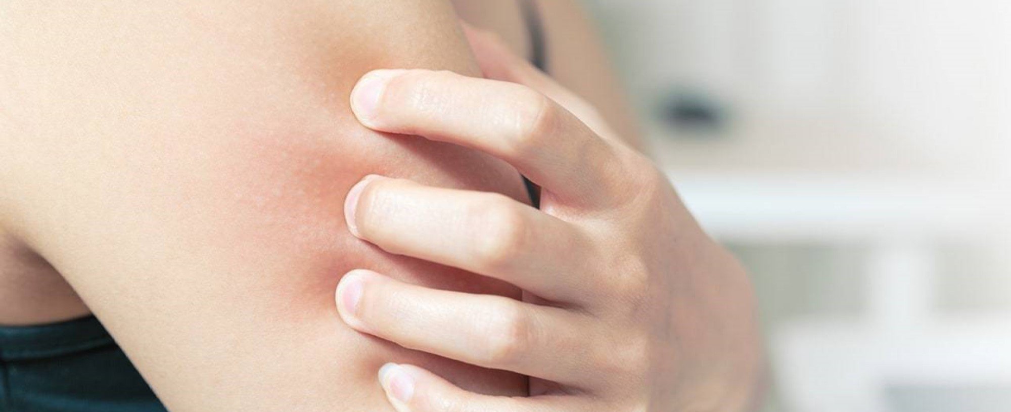 Loreal Paris BMAG Article What Causes Eczema D